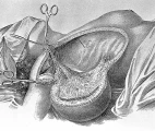 Halsted radical mastectomy. Source: wikimedia from Welcome Collection