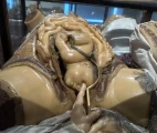 Fetal extraction with manual and instrumental obstetric assistance