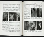 Fractures of pelvic and hip bones. The second volume of the Zimmer's Military medicine – War Experiences 1939–1943. Military Surgery