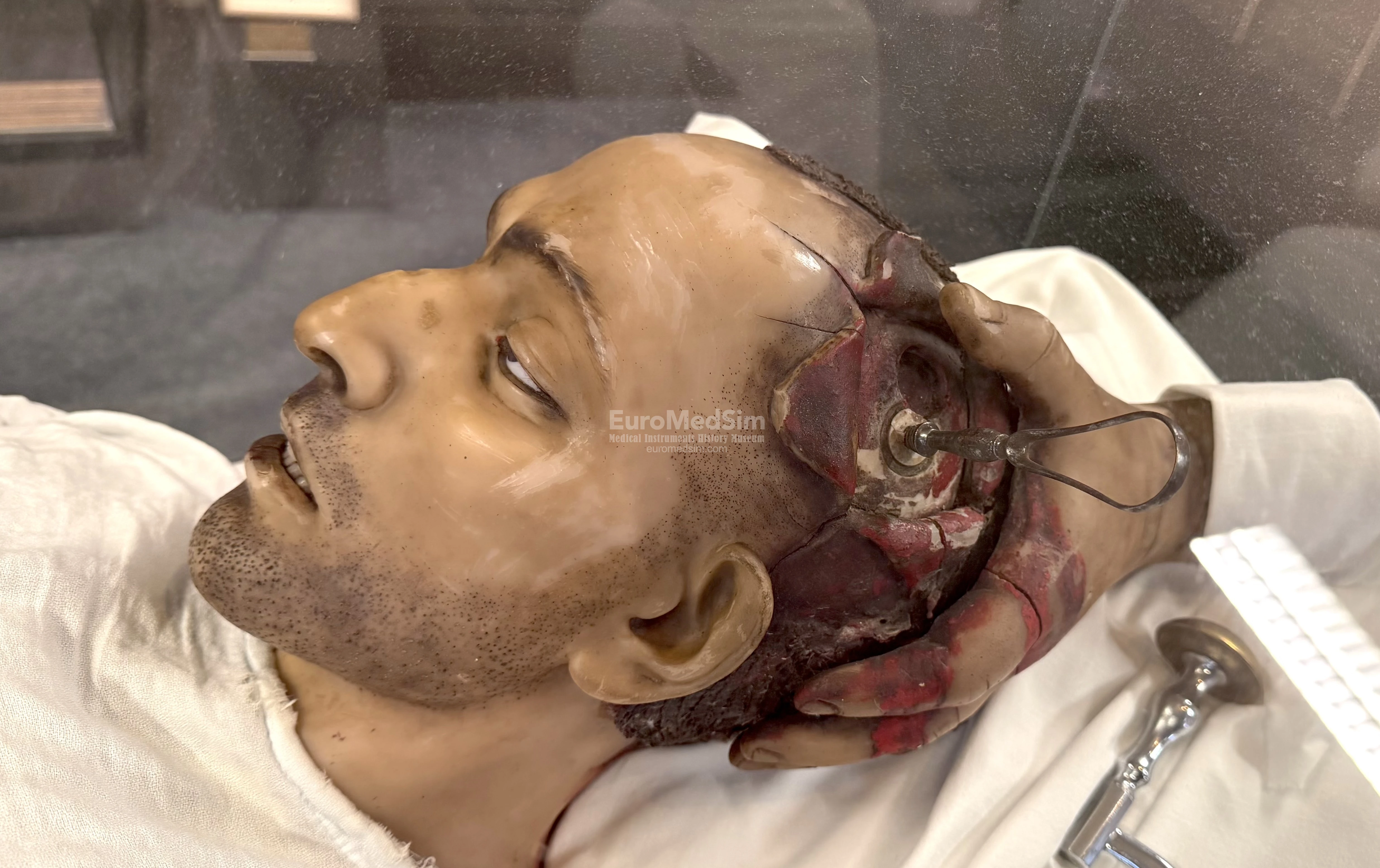 Wax model of trepanation. The Museum of Medicine, Campus Erasme of the Free University of Brussels