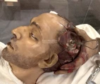 Wax model of trepanation. The Museum of Medicine, Campus Erasme of the Free University of Brussels