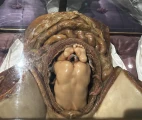 Fetus in uterus