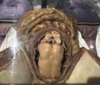 Fetus in uterus